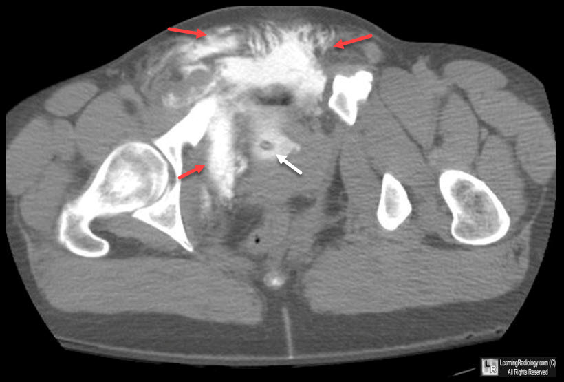 Extraperitoneal Bladder Rupture